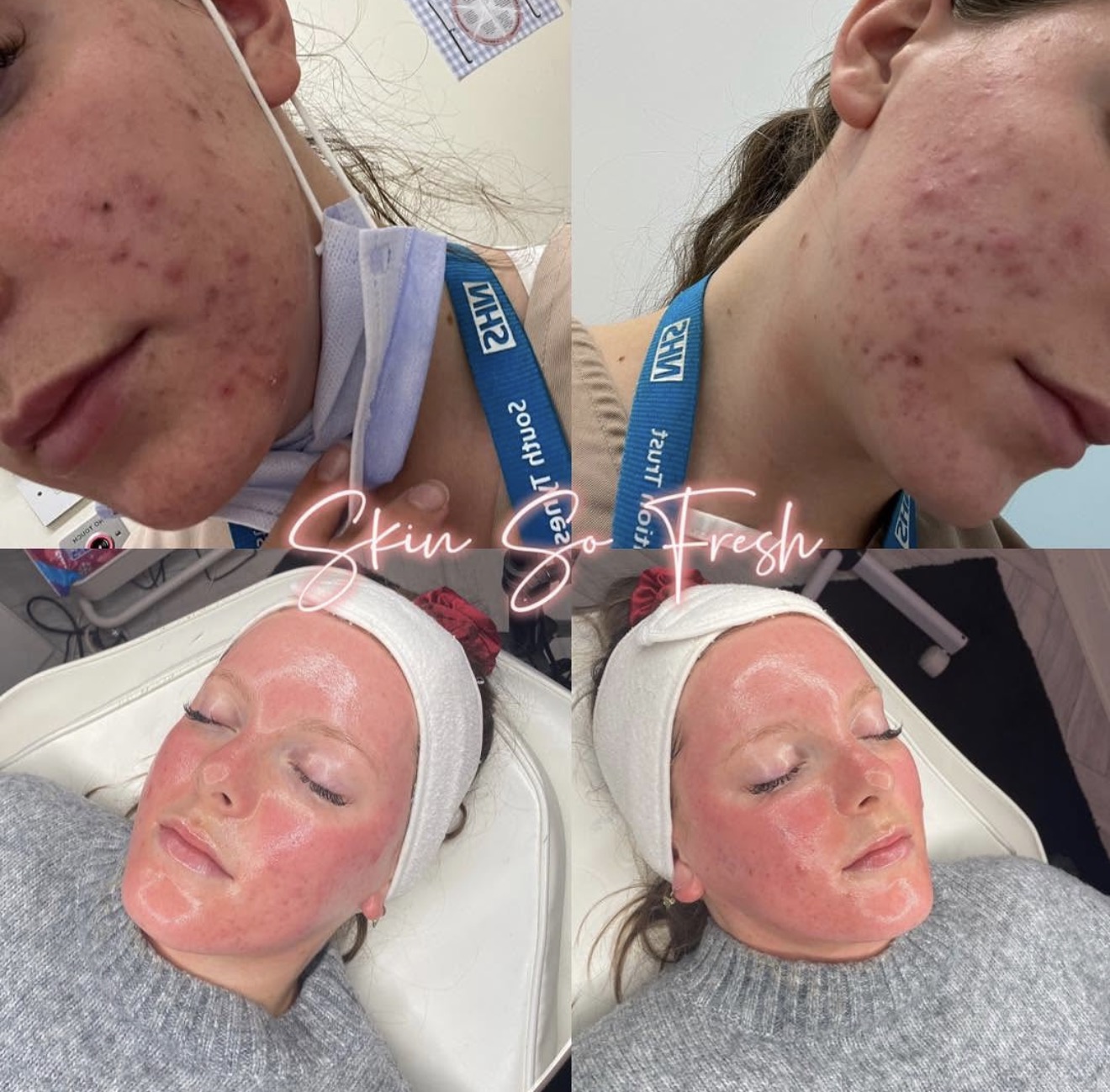 Skin So Fresh facial treatment results